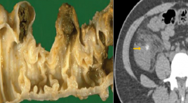 Đặc điểm hình ảnh Xquang cắt lớp vi tính của viêm túi thừa đại tràng