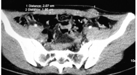 Lạc nội mạc tử cung vào cơ thành bụng sau mổ lấy thai và u tiểu khung được phát hiện tại trung tâm chẩn đoán hình ảnh AMTIC