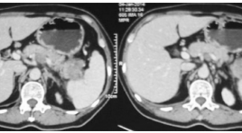 Nhân một trường hợp u lympho tụy được chụp và theo dõi trên PET/CT tại bệnh viện Việt Đức