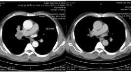 Đặc điểm hình ảnh và vai trò của chụp cắt lớp vi tính trong chẩn đoán và theo dõi điều trị hóa chất ung thư phổi không tế bào nhỏ