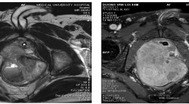Sarcoma cơ vân của tuyến tiền liệt (TTL) hình ảnh cộng hưởng từ