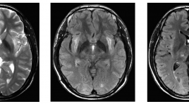 Nghiên cứu hình ảnh cộng hưởng từ não của 5 trường hợp nhiễm độc chì mạn tính