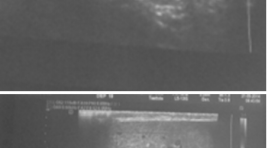 Đặc điểm hình ảnh siêu âm Triplex trong chẩn đoán xoắn tinh hoàn tại bệnh viện Việt Đức