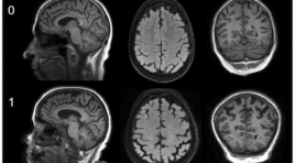 Mô tả đặc điểm hình ảnh cộng hưởng từ và hình ảnh18F-FDG PET/CT não ở các bệnh nhân mắc bệnh Alzheimer tại Bệnh viện Lão khoa Trung ương