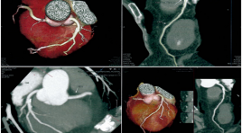Nhận xét bước đầu kết quả chụp cắt lớp vi tính 640 lớp cắt động mạch vành không sử dụng thuốc hạ nhịp tim tại bệnh viện đa khoa quốc tế Vinmec Đà Nẵng
