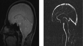 Giá trị của kỹ thuật PC-MRI trong đánh giá dòng chảy dịch não tủy ở người bình thường và BN não úng thủy do xuất huyết khoang dưới nhện