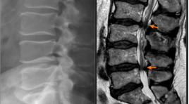Kết quả bước đầu tiêm thẩm phân lỗ tiếp hợp trong điều trị đau rễ thần kinh thắt lưng do thoát vị đĩa đệm tại bệnh viện Hữu Nghị