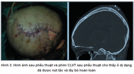 can thiệp nội mạch kết hợp phẫu thuận điều trị dị dạng thông động tĩnh mạch dưới da đầu phức tạp: Báo cáo trường hợp lâm sàng tại bệnh viện Việt Đức