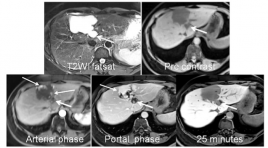 Chất tương phản MRI - PRIMOVIST: Vai trò trong chẩn đoán thương tổn gan 
