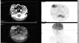 18FDG-PET/CT trong đánh giá giai đoạn và đáp ứng điều trị u lympho ác tính không hodgkin ngoài hạch