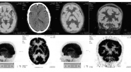 Đặc điểm hình ảnh 18F-FDG PET/CT não ở bệnh nhân Alzheimer và ở người lão hóa bình thường 