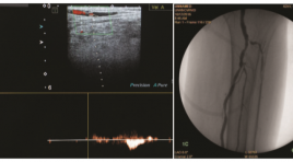 Đặc điểm hình ảnh siêu âm doppler và giá trị bổ sung của chụp mạch số hóa xóa nền trong chẩn đoán hẹp, tắc động mạch chi dưới 