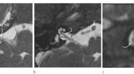Hình ảnh cắt lớp vi tính và cộng hưởng tử bất thường dây thần inh ốc tai trên 22 bệnh nhân  điếc tiếp nhận bẩm sinh 