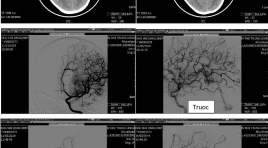 Đánh giá kết quả điều trị dị dạng động - tĩnh mạch não dã vỡ ở trẻ em bằng nút mạch onyx