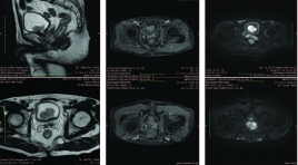 Nghiên cứu đặc điểm hình ảnh và giá trị CHT chẩn đoán phân độ giai đoạn T của ung thư bàng quang