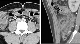 Đặc điểm hình ảnh X quang cắt lớp vi tính của viêm túi thừa đại tràng