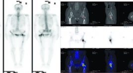 Mối liên quan giữa sUVMAX với hình thái tổn thương di căn xương trên 99MTC-MDP SPECT/CT ở bệnh nhân ung thư