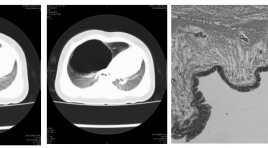 Đặc điểm hình ảnh và giá trị cắt lớp vi tính của  bất thường nang tuyến phổi bẩm sinh 