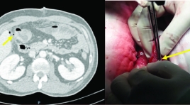 Đặc điểm hình ảnh X quang cắt lớp vi tính trong chẩn đoán bục xì miệng nối ống tiêu hóa