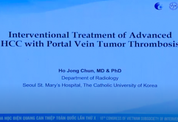 Interventional Treatment of advanced HCC with portal vein tumor thrombosis PVTT