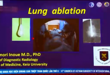 Lung ablation